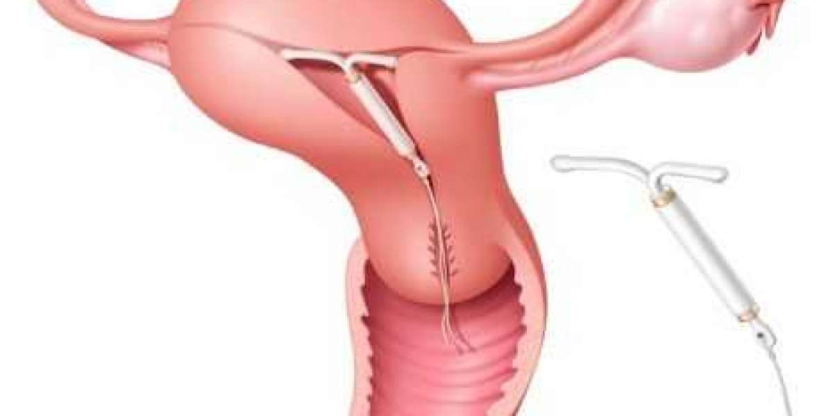 Descubriendo el DIU Mirena: ¿Qué hormona lo hace efectivo?